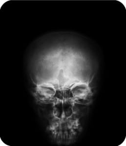 Image of an x-ray of a skull